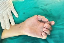 Bé trai 12 tuổi đứt lìa 2 ngón tay vì nghịch dao cắt cỏ