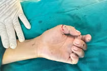 Bé trai 12 tuổi đứt lìa 2 ngón tay vì nghịch dao cắt cỏ