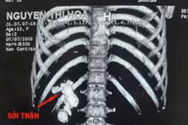 Phẫu thuật thành công ca sỏi thận san hô phức tạp