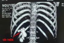 Phẫu thuật thành công ca sỏi thận san hô phức tạp