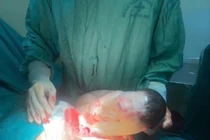 Em bé sinh ra trong "bọc điều" hiện tượng hiếm thấy