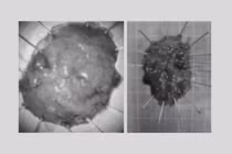 Phẫu thuật nội soi cắt 2 polyp "khổng lồ" cho cụ ông 73 tuổi