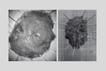 Phẫu thuật nội soi cắt 2 polyp "khổng lồ" cho cụ ông 73 tuổi