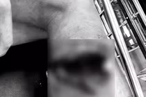 Nam sinh 15 tuổi ở Hà Nội cẳng chân bị đứt lìa được phẫu thuật nối thành công