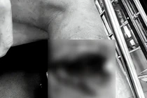 Nam sinh 15 tuổi ở Hà Nội cẳng chân bị đứt lìa được phẫu thuật nối thành công