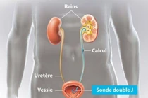 Bệnh nhân hơn 10 năm quên ống thông JJ trong cơ thể được lấy thành công