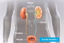 Bệnh nhân hơn 10 năm quên ống thông JJ trong cơ thể được lấy thành công