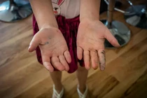 Nhiễm giun sán gây ảnh hưởng gì đối với sức khỏe?