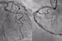 Cứu sống ngoạn mục người bệnh ngưng tim 2 lần do nhồi máu cơ tim cấp