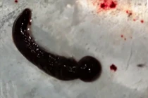 Con đỉa dài 6 cm sống trong mũi người phụ nữ suốt 3 tuần