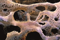 Loãng xương nặng ở phụ nữ sau mãn kinh