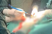 Người phụ nữ bị u xơ tử cung biến chứng hiếm gặp, đe dọa tính mạng 