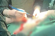 Người phụ nữ bị u xơ tử cung biến chứng hiếm gặp, đe dọa tính mạng 