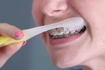 Biến chứng nghiêm trọng sau quá trình niềng răng kéo dài