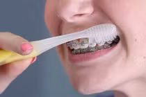 Biến chứng nghiêm trọng sau quá trình niềng răng kéo dài