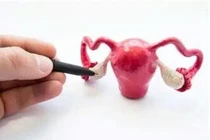 U nang buồng trứng xoắn đe dọa tính mạng bé gái 14 tuổi