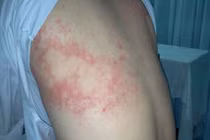 Bệnh giun sán gia tăng tại Khánh Hòa, 291 ca dương tính trong 14 ngày