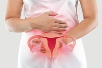 Mỗi năm, hàng ngàn phụ nữ Việt phát hiện ung thư cổ tử cung ở giai đoạn muộn