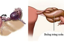 Cảnh báo nguy cơ xoắn buồng trứng, phụ nữ cần chú ý triệu chứng bất thường
