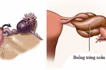 Cảnh báo nguy cơ xoắn buồng trứng, phụ nữ cần chú ý triệu chứng bất thường