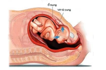 Cứu sống sản phụ 39 tuổi vỡ tử cung nguy kịch