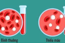 Dấu hiệu thiếu máu dễ nhận biết, cách phòng ngừa