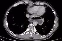 Tạo hình thực quản bằng đại tràng cho bệnh nhân ung thư