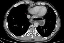 Tạo hình thực quản bằng đại tràng cho bệnh nhân ung thư