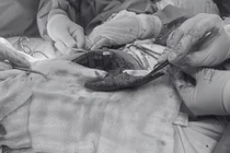 Chữa ung thư lưỡi giai đoạn muộn bằng kỹ thuật vi phẫu hiện đại