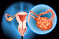 Phát hiện sớm u nang buồng trứng giúp phòng ngừa ung thư