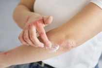 Chăm sóc da đúng cách mùa đông để giảm vảy nến