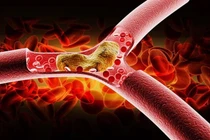 Mỡ máu cao nên uống nước gì?