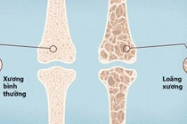 Loãng xương ở Việt Nam ngày càng gia tăng, đe dọa sức khỏe người cao tuổi