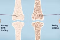 Loãng xương ở Việt Nam ngày càng gia tăng, đe dọa sức khỏe người cao tuổi