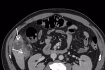 Người đàn ông 52 tuổi bị áp xe gan do nuốt phải xương