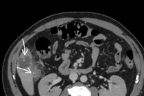 Người đàn ông 52 tuổi bị áp xe gan do nuốt phải xương