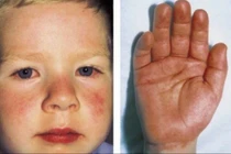 Nhận biết dấu hiệu bệnh Kawasaki