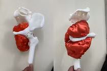 Ca phẫu thuật ung thư xương chậu hiếm gặp tại TP HCM