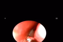 Phát hiện dị vật trong mũi trẻ 3 tuổi gây viêm mũi xoang nặng