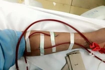 Cứu sống bệnh nhân suy tim cấp nặng nhờ kỹ thuật lọc máu liên tục