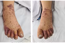 Từ vụ cụ bà bán lòng mắc liên cầu lợn, bác sĩ cảnh báo