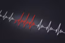 Xác định, xử lý nhịp nhanh kịch phát trên thất trong cấp cứu