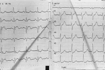 Can thiệp đặt stent, cứu bệnh nhân nhồi máu cơ tim sau phẫu thuật nội soi