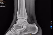 Nuốt nghẹn khi ăn, người phụ nữ đi khám được phát hiện mắc 6 bệnh cùng lúc