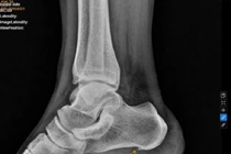 Nuốt nghẹn khi ăn, người phụ nữ đi khám được phát hiện mắc 6 bệnh cùng lúc