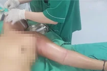 Người đàn ông suýt mất mạng do tự tiêm mật gấu chữa đau ngực