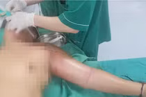 Người đàn ông suýt mất mạng do tự tiêm mật gấu chữa đau ngực