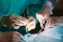 Phẫu thuật thành công cho người phụ nữ mắc khối u ác tính cột sống hiếm gặp 