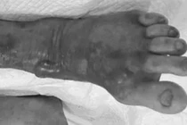 Vi khuẩn Vibrio vulnificus đe dọa tính mạng qua vết thương hở