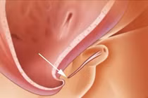 5 dấu hiệu lỗ tiểu thấp ở trẻ không thể bỏ qua